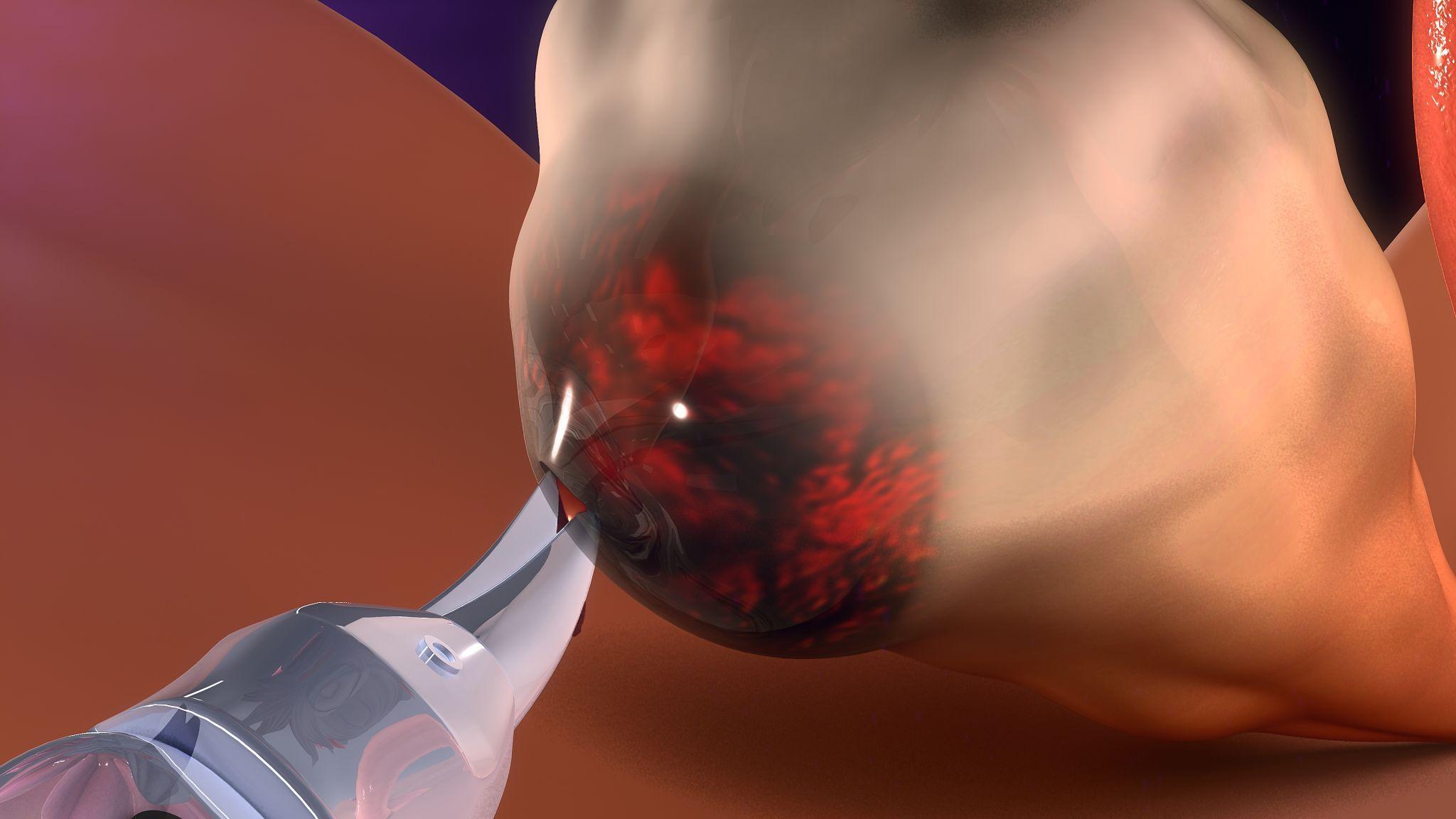 Radical Ovarian Cystectomy Surgery in Pune – Advanced Ovarian Treatment